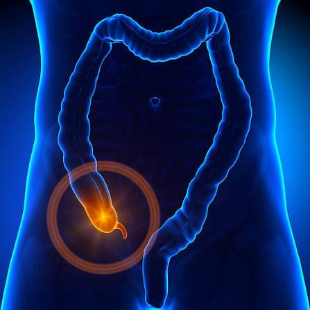 Apendicitis
