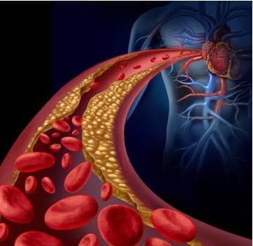 Arteriosclerosis / Ateromatosis