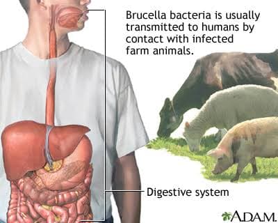 Brucelosis