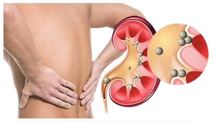 Cálculo renal