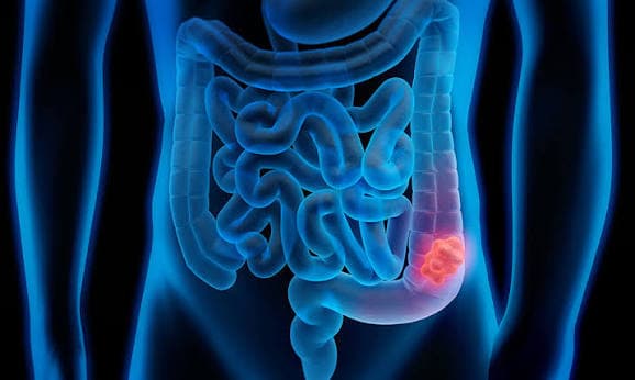 Cáncer colorrectal
