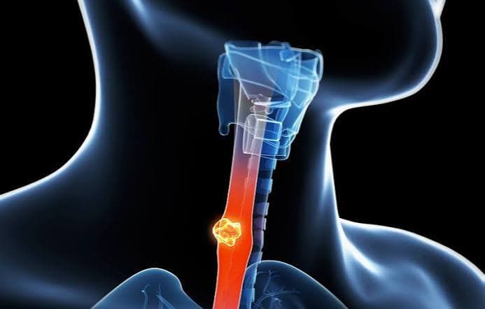 Cáncer de esófago