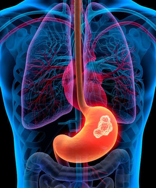 Cáncer gástrico (estómago)