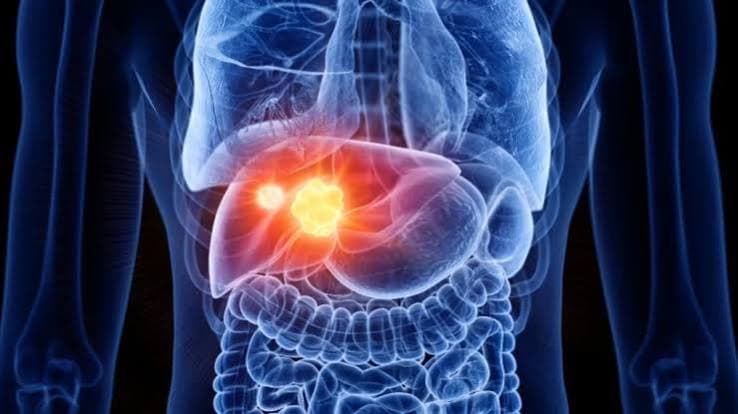 Cáncer de hígado