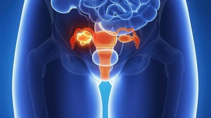 Cáncer de ovario