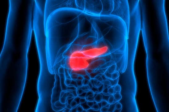 Cáncer pancreático