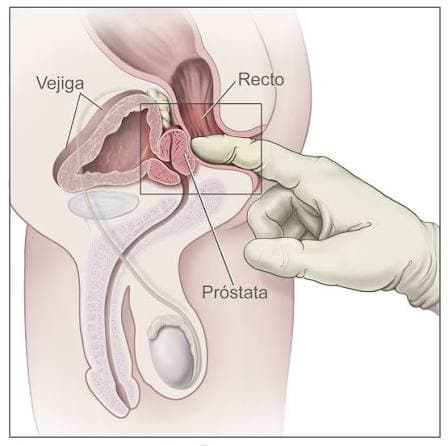 Cáncer de próstata