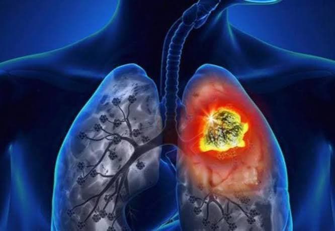 Cáncer de pulmón