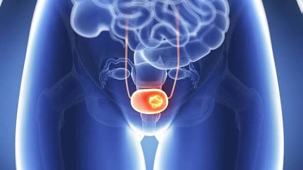 Cáncer uterino