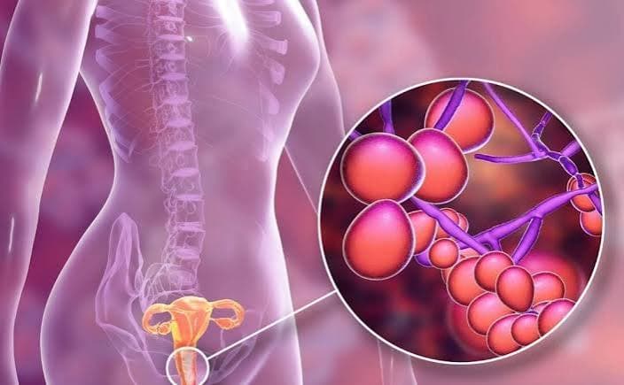 Candidiasis (vaginal)