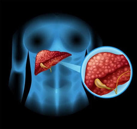 Cirrosis hepática