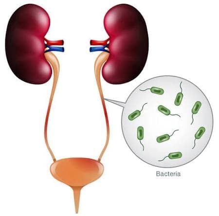 Cistitis o infección urinaria