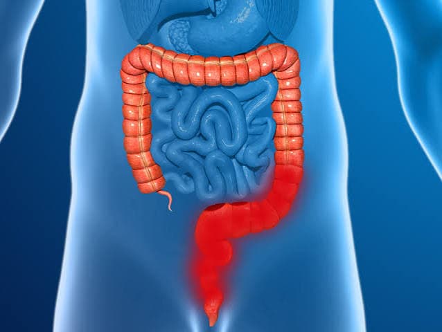 Colitis ulcerosa