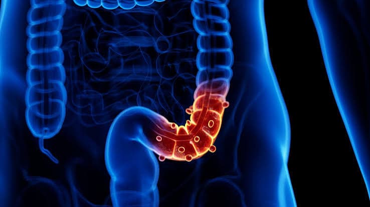 Diverticulitis