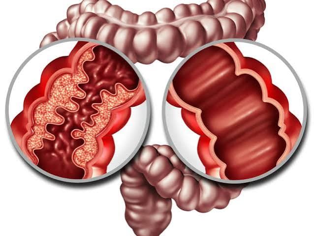 Enfermedad de Crohn