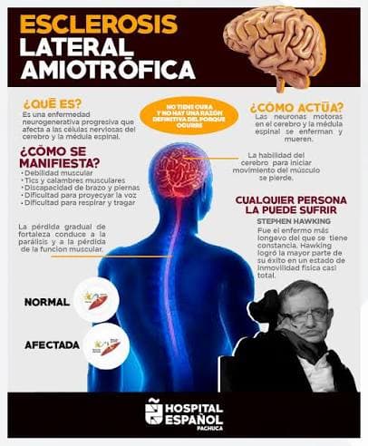 Esclerosis lateral amiotrófica (ELA)