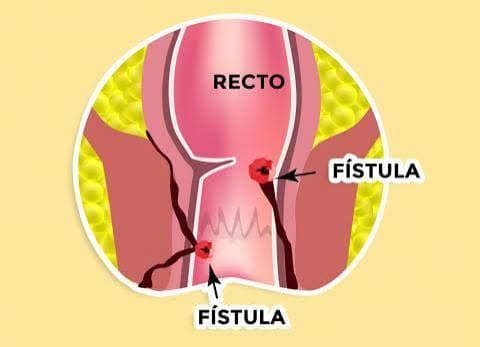 Fístula anal