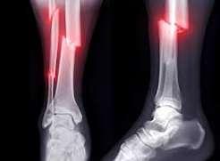 Fractura
