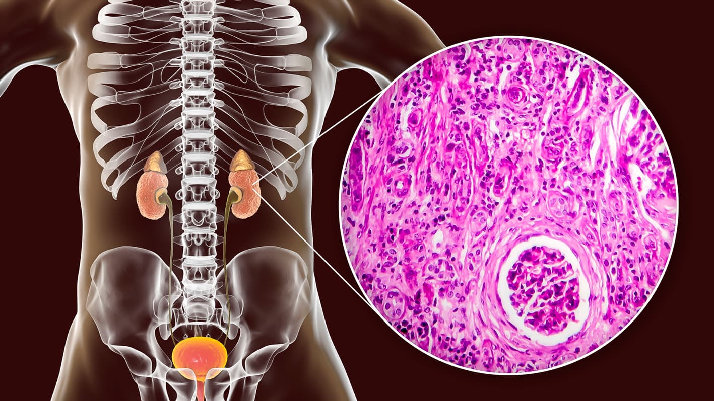 Glomerulonefritis posestreptocócica (Síndrome Nefrítico)