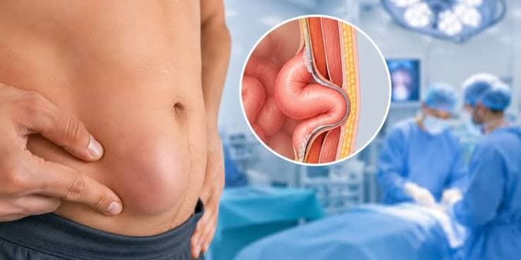 Hernia