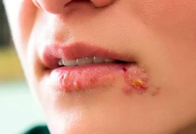 Herpes