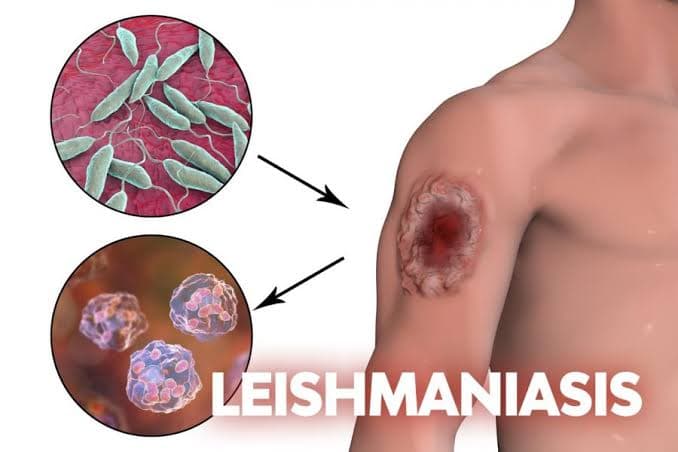 Leishmaniasis cutánea