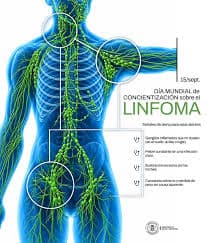 Linfoma