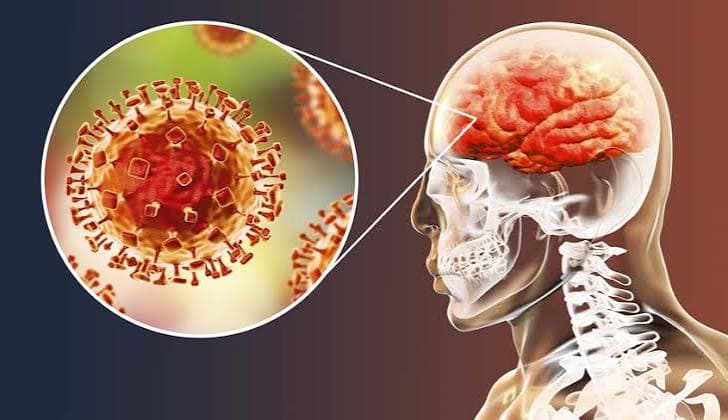 Meningitis