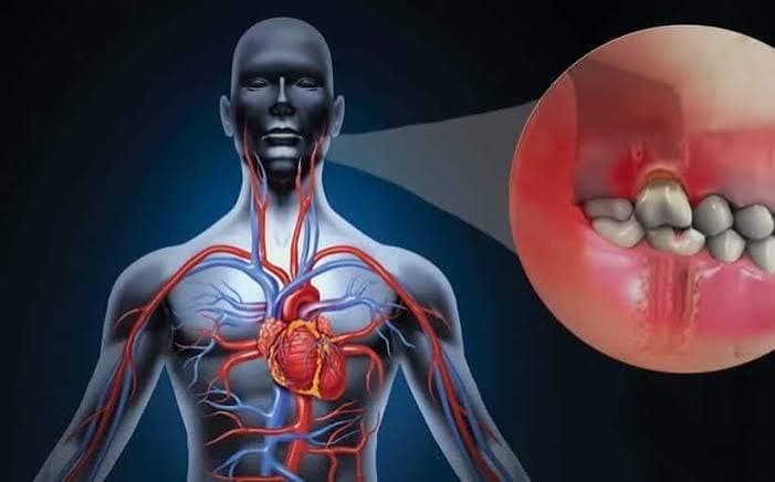 Periodontitis
