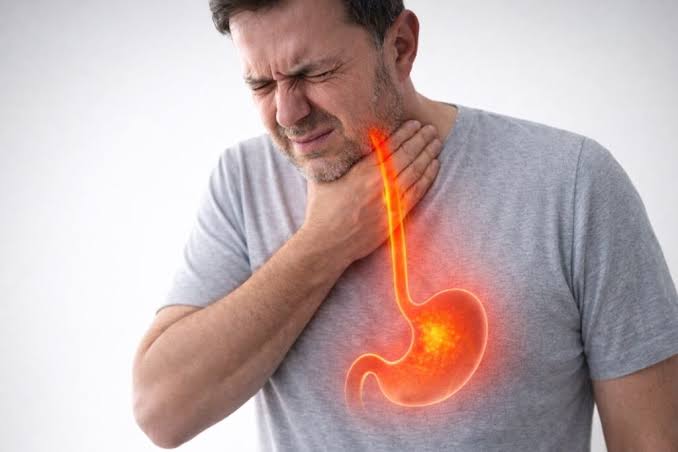 Reflujo gastroesofágico