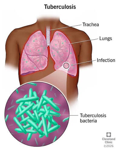 Tuberculosis