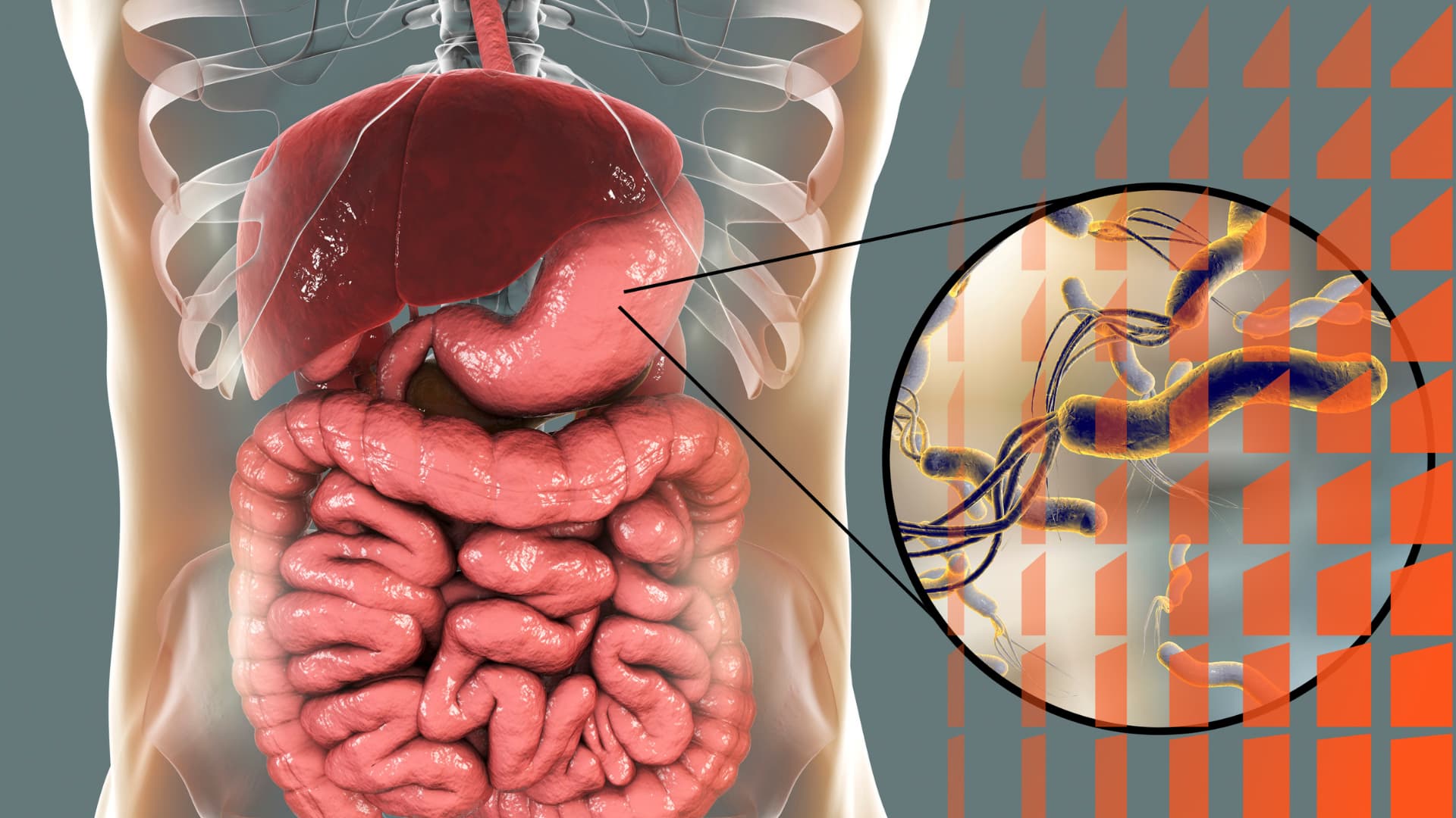 Úlceras pépticas (Helicobacter pylori)