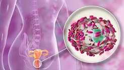 Vaginosis bacteriana