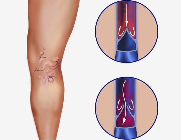 Varices (insuficiencia venosa crónica)